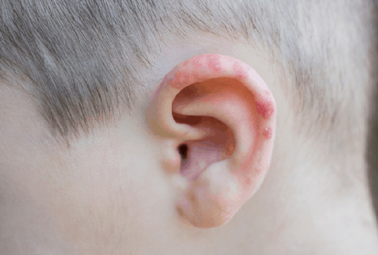 Zona thần kinh ở tai có nguy hiểm? Làm sao chữa?