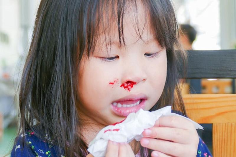 Chảy máu cam ở trẻ: Nguyên nhân và cách xử lý an toàn nhất