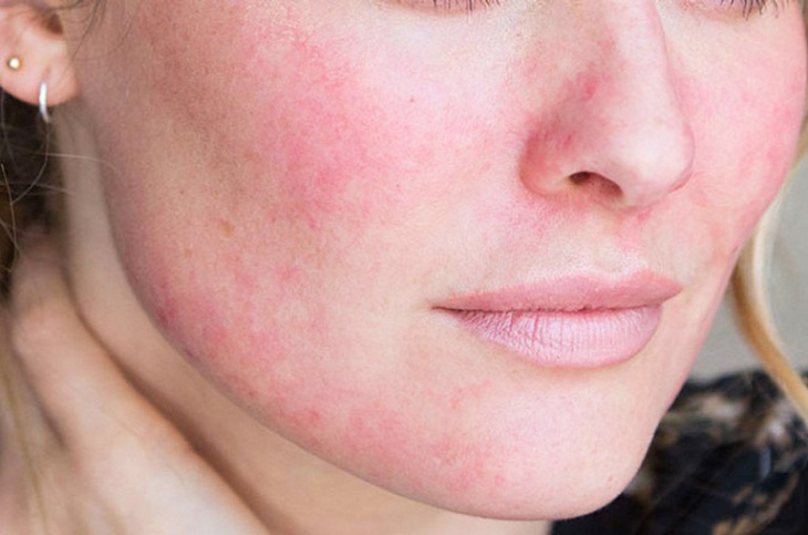 Da mặt nổi mẩn đỏ không ngứa: Nguyên nhân và hướng điều trị lành tính