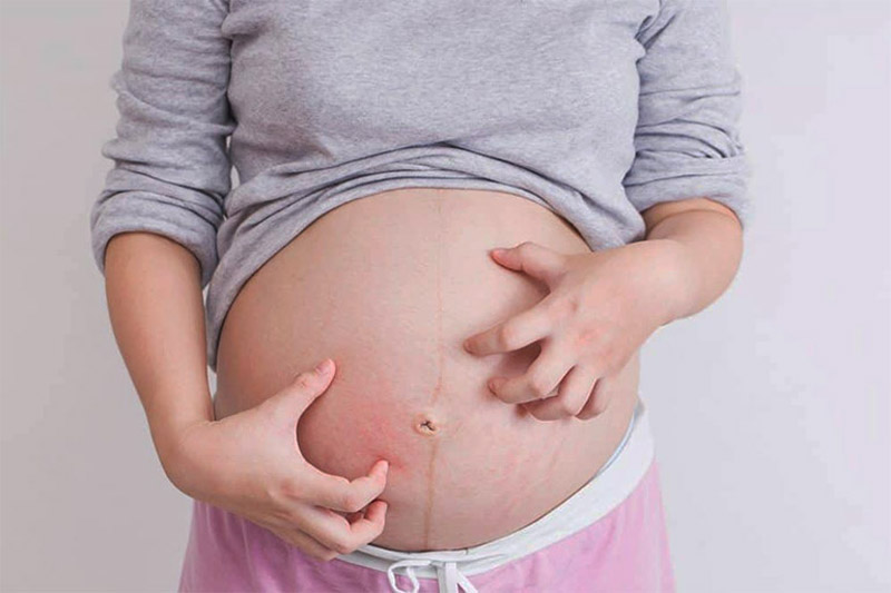 Nổi mề đay khi mang thai: Cách điều trị & lưu ý quan trọng cho bà bầu