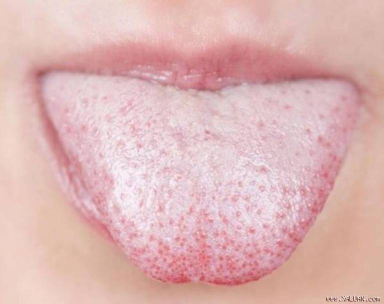 Lưỡi trắng hôi miệng là dấu hiệu của bệnh gì?