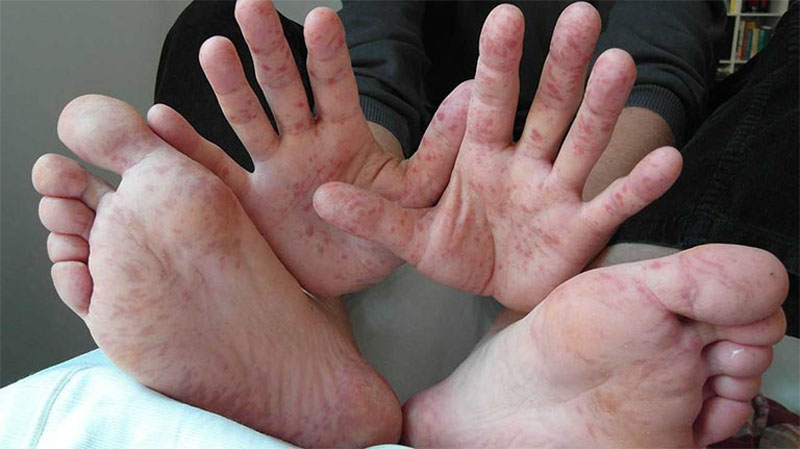 Ngứa chân tay là dấu hiệu của bệnh gì? Điều trị như thế nào?