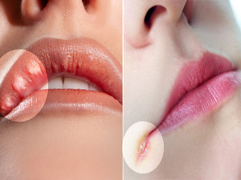 Ngứa môi là bệnh gì? Cách nhận biết và điều trị hết ngứa, mềm môi hiệu quả