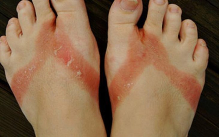 Nổi mẩn đỏ ngứa ở chân là dấu hiệu của bệnh gì? Điều trị như thế nào?
