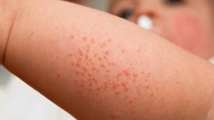 Nổi mẩn đỏ khắp người không sốt không ngứa ở người lớn là gì? Cách điều trị