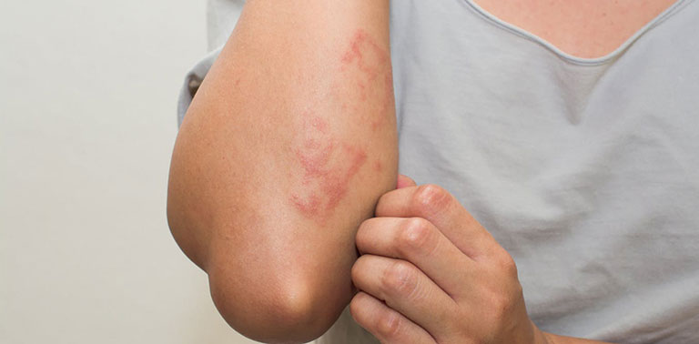 Nổi đốm đỏ trên da không ngứa – Dấu hiệu của nhiều bệnh nguy hiểm