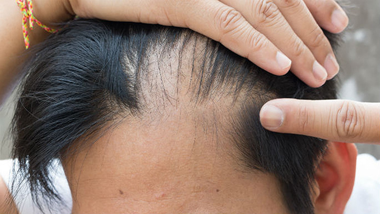 Rụng tóc ở nam giới – Dấu hiệu nhiều bệnh lý đáng chú ý