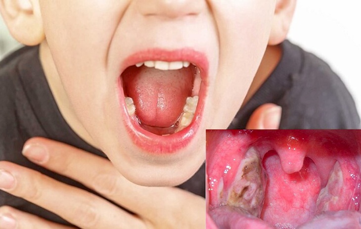 Trẻ bị viêm họng hạt có mủ nguy hiểm không? Cách điều trị bệnh?