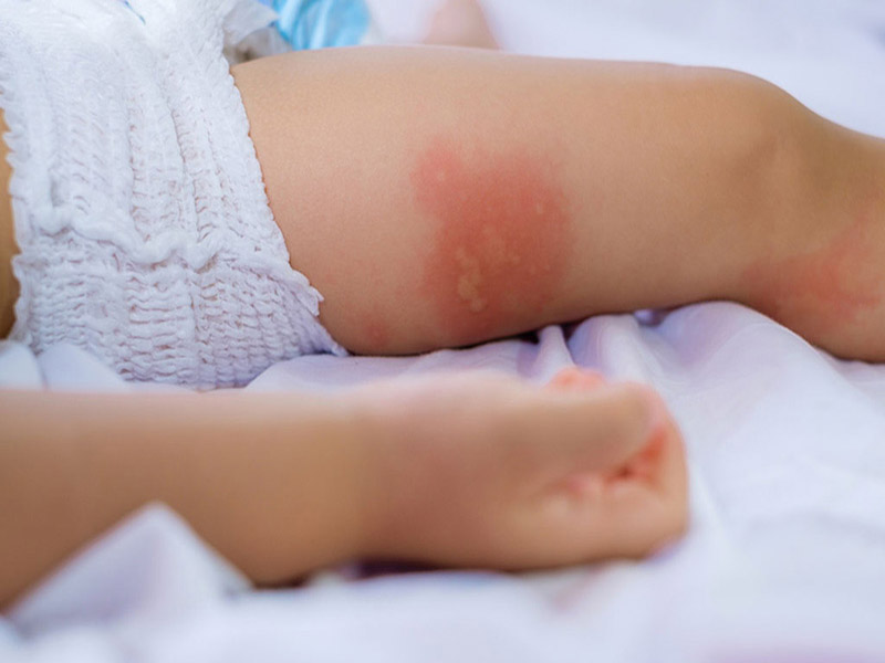 Viêm da tiếp xúc ở trẻ em: Triệu chứng điển hình và điều trị hiệu quả, an toàn cho bé