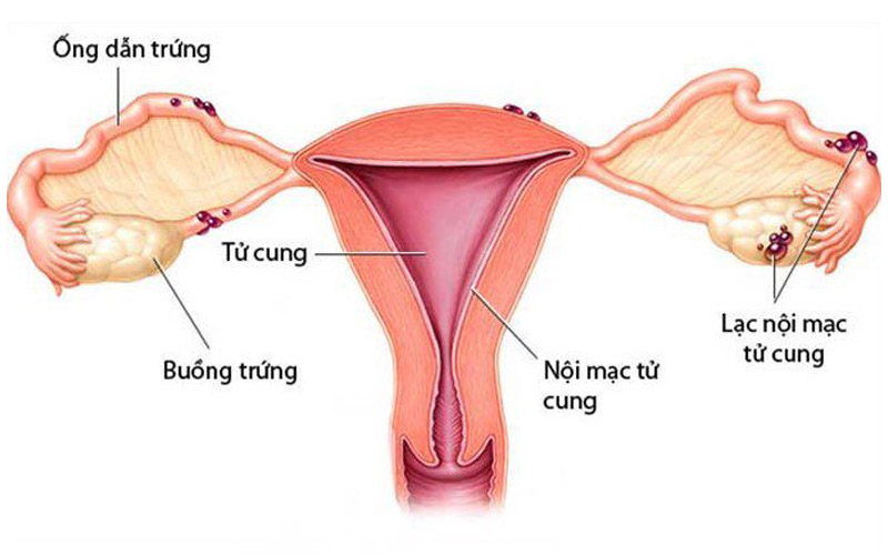 U lạc nội mạc tử cung là gì? Triệu chứng, chẩn đoán và cách điều trị cụ thể