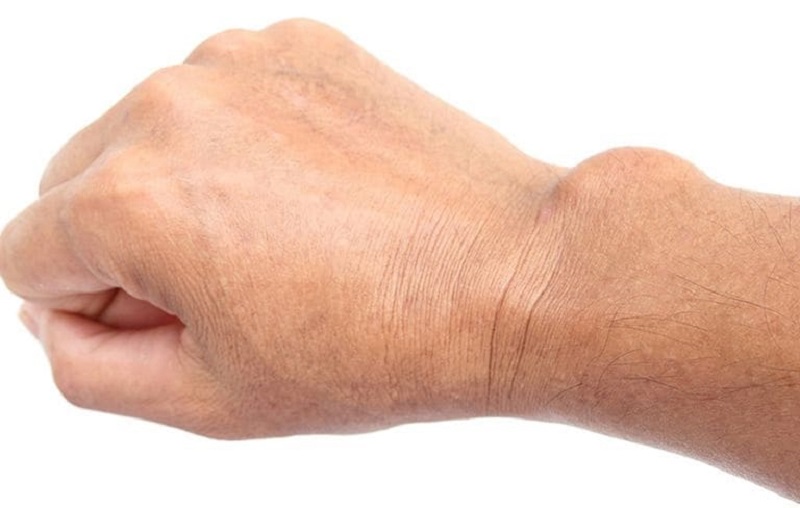 Viêm bao hoạt dịch khớp cổ tay: Nguyên nhân và cách điều trị