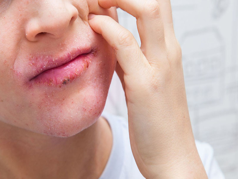 Viêm da cơ địa ở mặt, môi: Dấu hiệu và cách điều trị không để lại sẹo?