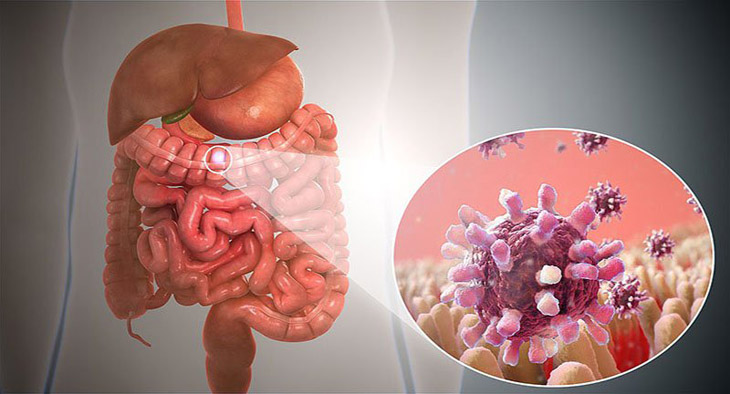 Viêm dạ dày ruột cấp: Những thông tin tổng quan cần biết về căn bệnh tiêu hóa phổ biến