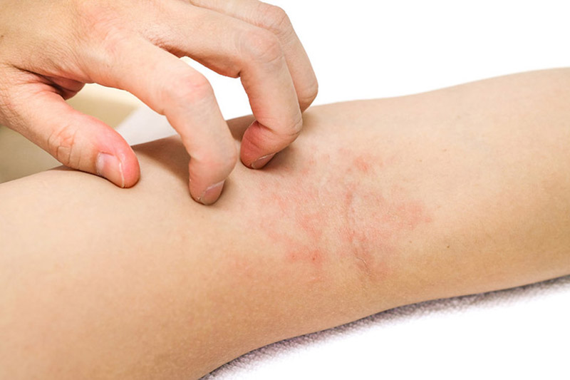 Viêm da – Nguyên nhân, triệu chứng, phân loại và cách điều trị hiệu quả