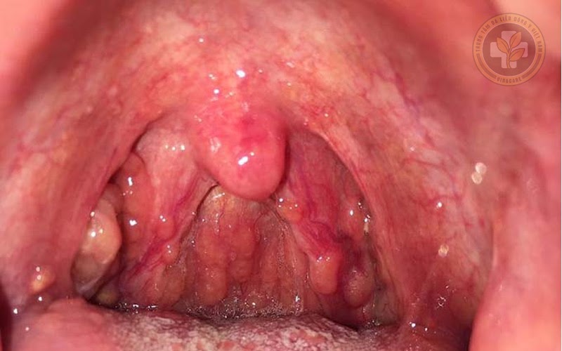 Viêm họng hạt có nguy hiểm không? Bệnh có chữa khỏi được không?