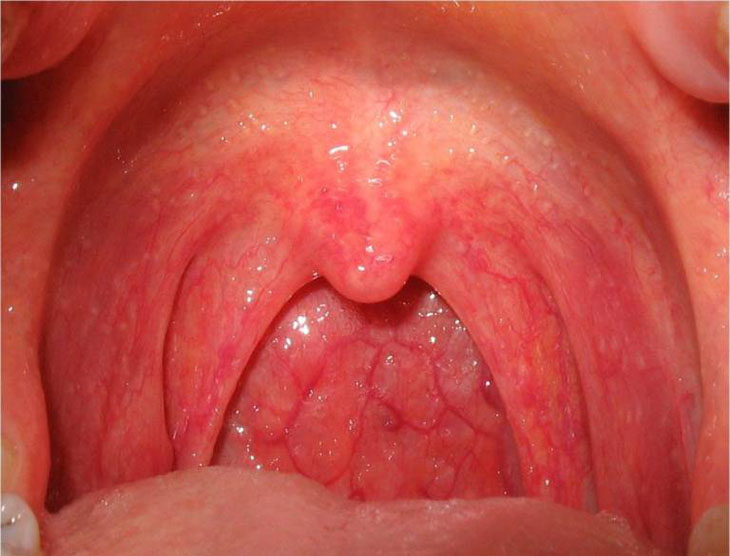 Viêm họng phù nề: Dấu hiệu cần biết phòng tránh ung thư vòm họng