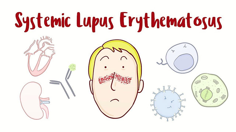 Bệnh Lupus ban đỏ hệ thống – Hình ảnh, dấu hiệu & điều trị