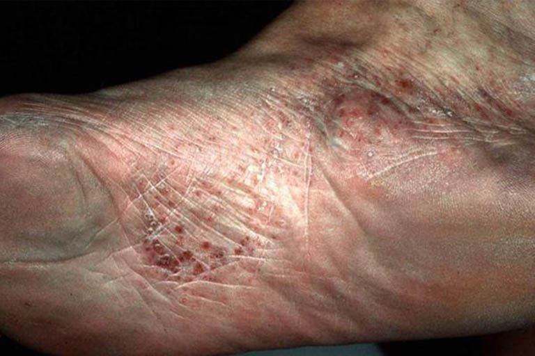 Bệnh tổ đỉa ở bàn chân: Dấu hiệu và cách điều trị