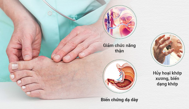 Bệnh gout: Triệu chứng, nguyên nhân và cách điều trị hiệu quả