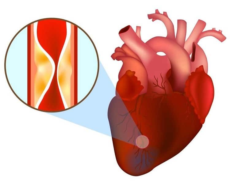 Biến chứng nhồi máu cơ tim: Nguy hiểm hơn bạn nghĩ