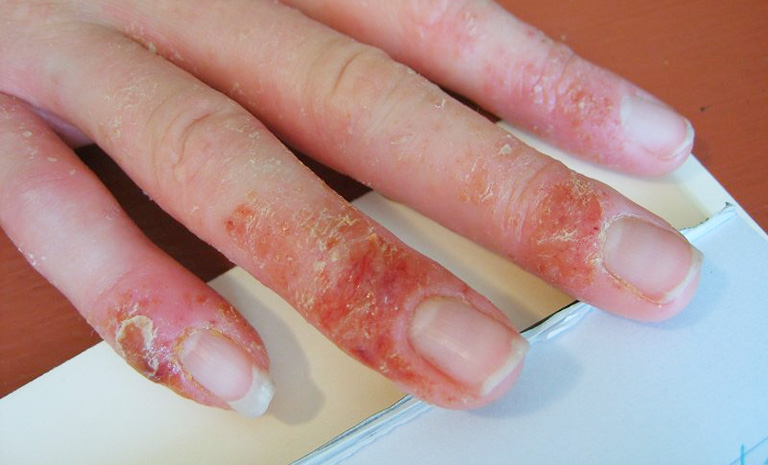 Bệnh chàm khô đầu ngón tay: Dấu hiệu nhân biết và cách chữa