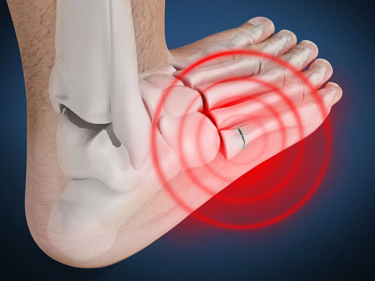 Nguyên nhân đau khớp bàn chân thường gặp & cách điều trị