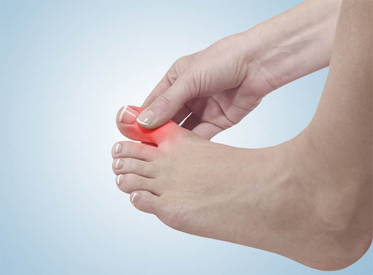 Đau sưng khớp ngón chân cái – Có phải bệnh gút?