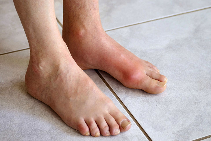 Gout cấp tính: Cách điều trị và lưu ý khi mắc bệnh