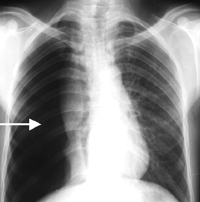 Nguyên nhân, triệu chứng và cách điều trị lao màng phổi