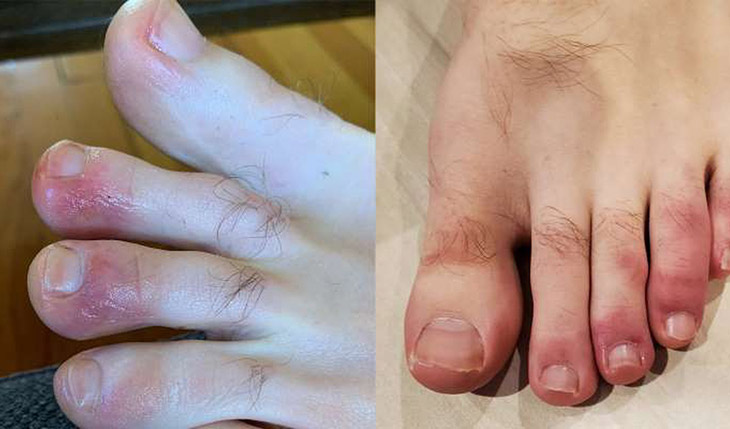 Ngứa đầu ngón tay ngón chân nguyên nhân do đâu? Cách điều trị hiệu quả