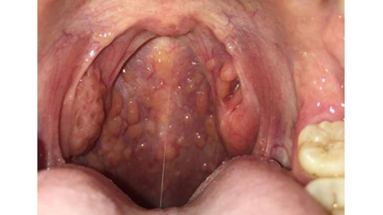 Nổi hạt trong cổ họng, vòm họng là bị gì, có phải ung thư?