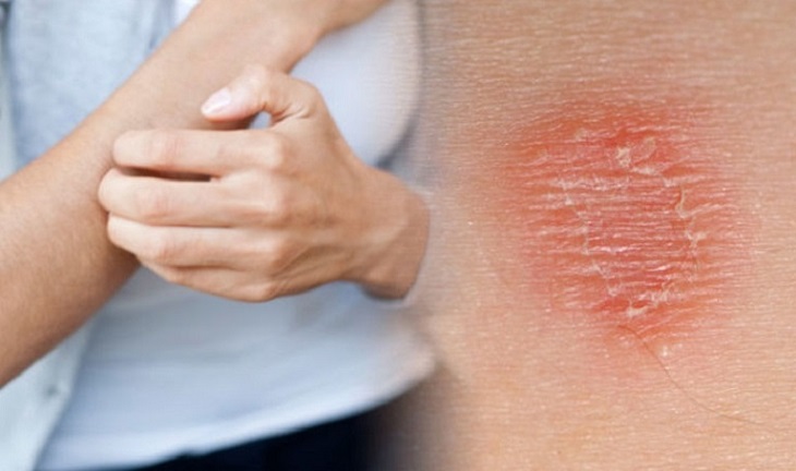 Bị ngứa da vào ban đêm có phải dấu hiệu nguy hiểm không? Phương pháp điều trị hiệu quả nhất.