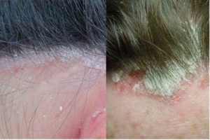 Bệnh vẩy nến da đầu và cách điều trị hiệu quả hoàn toàn từ thảo dược
