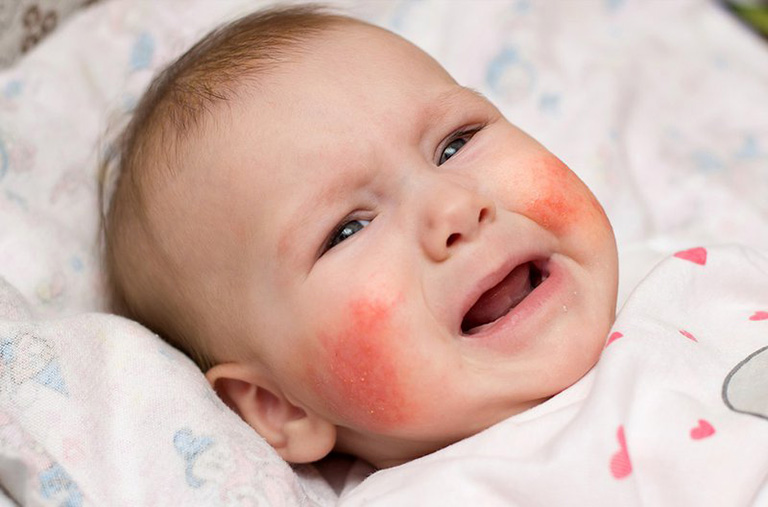 Viêm da cơ địa ở trẻ em – Nguyên nhân, triệu chứng & điều trị