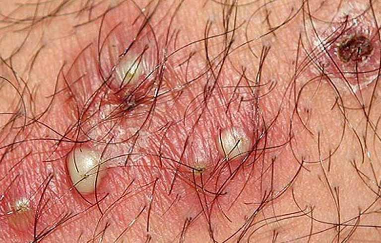 Bệnh viêm nang lông – Nguyên nhân, biểu hiện, cách điều trị