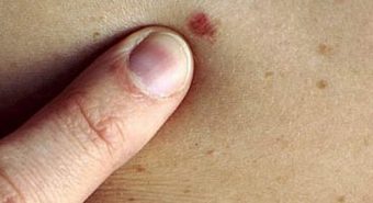 Nguy cơ ung thư biểu mô tế bào có vảy nếu có nhiều virus HPV