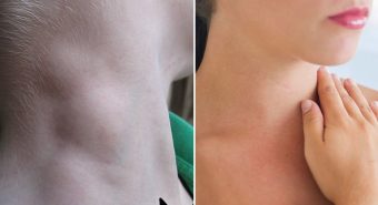 Nổi hạch to có phải dấu hiệu bệnh ung thư hạch?