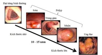 Phát hiện ung thư đại tràng thông qua khám sàng lọc