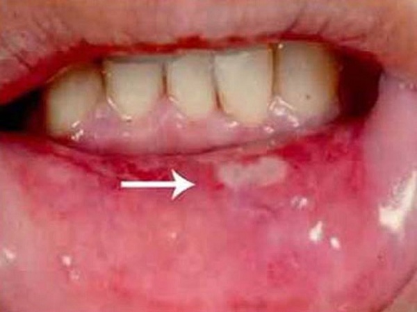 Hình ảnh người bị ung thư biểu mô vùng miệng