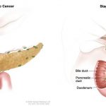 Các phương pháp chẩn đoán ung thư tụy sớm