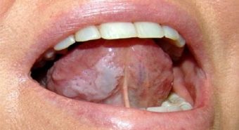 Cần biết cách phân biệt bệnh ung thư lưỡi và nhiệt miệng