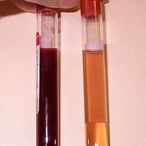Xuất hiện máu trong nước tiểu – dấu hiệu ung thư bàng quang