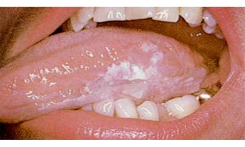 Lưỡi xuất hiện các mảng đốm trắng có thể là dấu hiệu ung thư lưỡi
