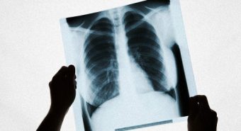 Câu hỏi trắc nghiệm kiểm tra nguy cơ mắc ung thư phổi