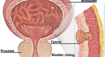 Chẩn đoán ung thư bàng quang và định hướng điều trị