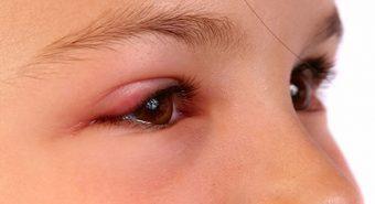 Có thể trị khỏi bệnh ung thư mi mắt hay không?