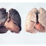 Dấu hiệu và nguyên nhân bệnh ung thư phổi