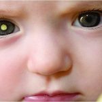 Di truyền có phải là nguyên nhân gây bệnh ung thư mắt?