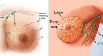 Đồ ăn nhanh – một trong những nguyên nhân gây bệnh ung thư vú