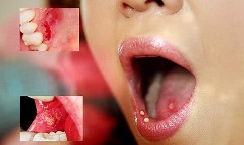 Giải đáp các thắc mắc về bệnh ung thư miệng